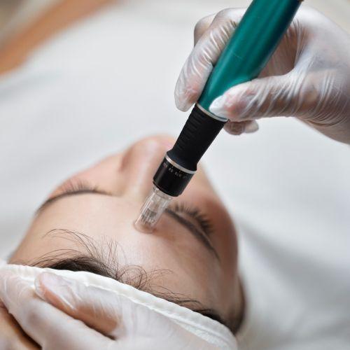 AUGEN MICRONEEDLING